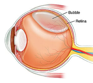 La viteolisis neumática o burbuja de gas se inserta en el ojo para tratar la tracción vítreomacular en West Texas Eye Associates.