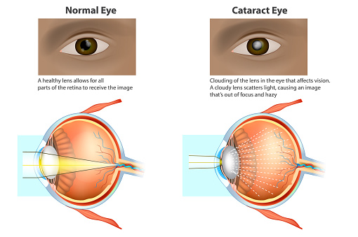 Cataracts is a clouding of the lens. Medical illustration of a normal eye and an eye with a cataract, clouded lens