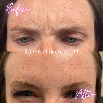 Botox in the 11s before and after