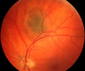 Choroidal nevus documented with retinal imaging at West Texas Eye Associates