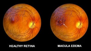 Edema macular frente a retina sana en West Texas Eye Associates
