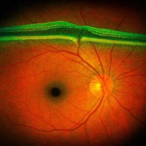 Retinal imaging scan showing macular hole causing dark spot in central vision. Learn more about our retinal services at West Texas Eye Associates