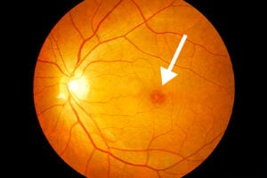 how do i know if i have a macular hole fundus photograph showing a central macular hole indicated by a white arrow - West Texas Eye Associates