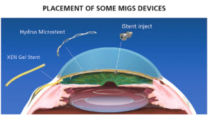 Ilustración que muestra la colocación de los dispositivos MIGS durante la cirugía microinvasiva de glaucoma (MIGS), incluyendo el microstent Hydrus, el stent de gel XEN y el iStent inject posicionados en el sistema de drenaje del ojo.
