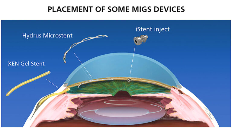 Microinvasive Glaucoma Surgery (MIGS) surgery in West Texas