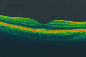 Especialista en retina en Lubbock, tomografía de coherencia óptica (OCT) de sección transversal macular con capas retinianas visibles y contorno foveal.