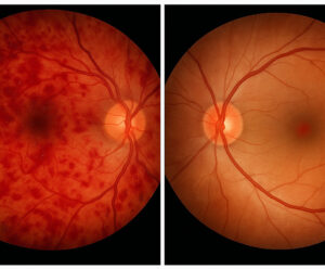 Especialista en retina en Lubbock, imágenes de fondo de ojo una al lado de la otra que muestran oclusión de la vena retiniana y oclusión de la rama de la arteria retiniana.