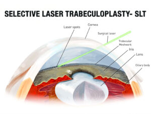 Trabeculoplastia selectiva con láser (SLT) en West Texas Eye Associates, paciente sometido a tratamiento láser para glaucoma con lámpara de hendidura.