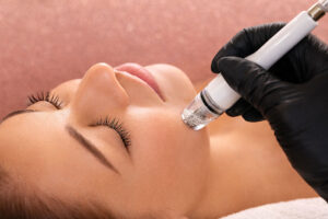 DiamondGlow is an effecticve acne treatment from Aesthetic Center of Lubbock in West Texas.