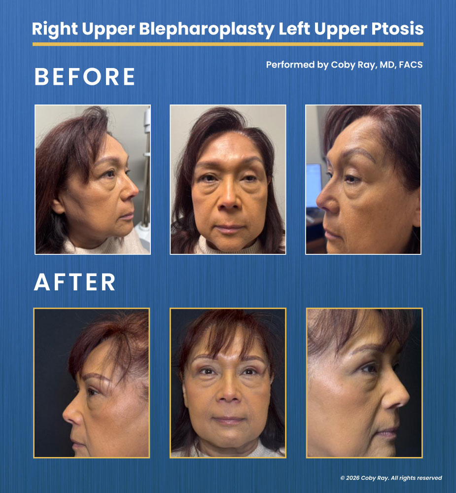 Before and after ptosis repair with blepharoplasty showing improved eyelid position and symmetry performed by Dr. Coby Ray in Lubbock TX.