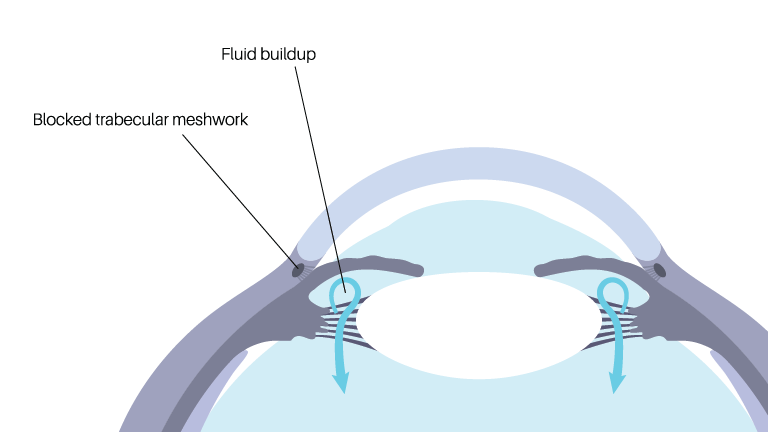 Imagery of blocked trabecular meshwork that can happen with glaucoma.