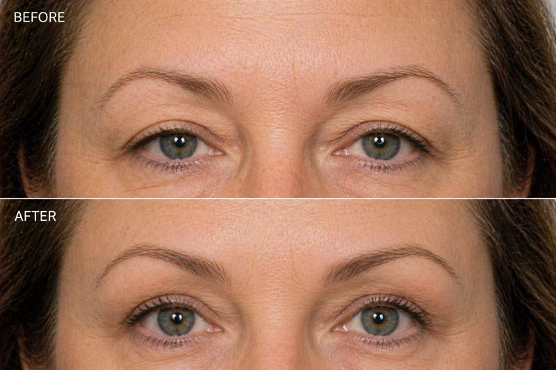 A woman with a before and after of her brow lift.