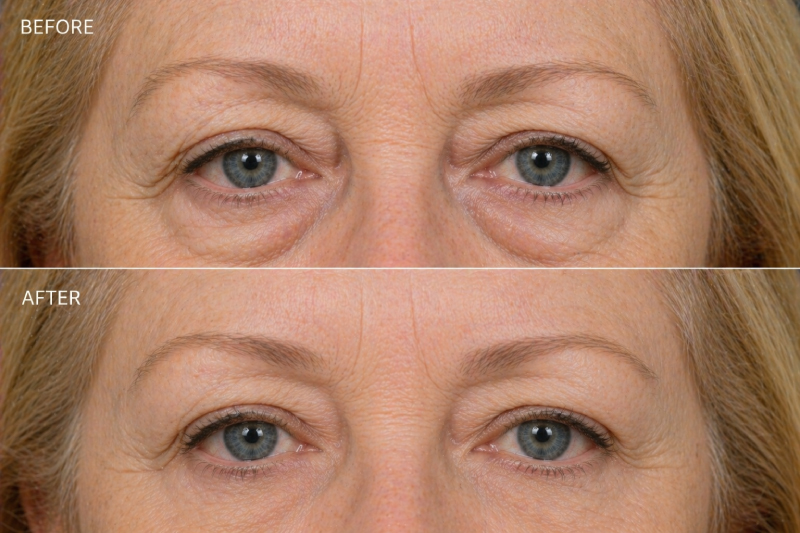 Women's before and after lower blepharoplasty surgery.