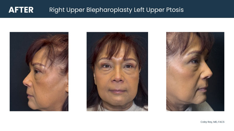 Patient shown from front and side angles with upper eyelid heaviness and ptosis after to right upper blepharoplasty and left upper ptosis repair by Dr. Coby Ray.