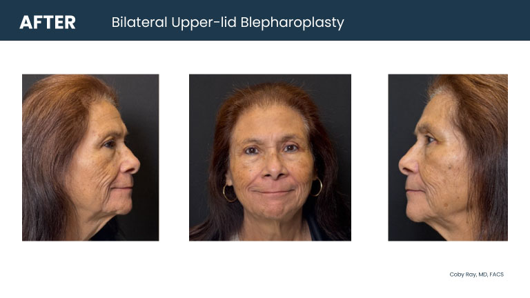Patient shown from front and side angles after bilateral upper-lid blepharoplasty by Dr. Coby Ray, showing a more open upper eyelid appearance.