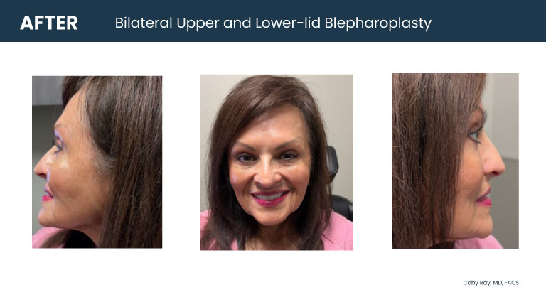 Patient shown from front and side angles after bilateral upper and lower-lid blepharoplasty by Dr. Coby Ray, showing a smoother lower eyelid area and more open upper eyelid appearance.