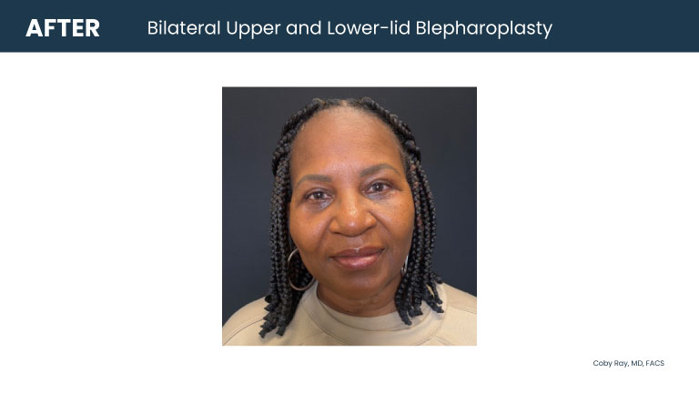 Patient shown after bilateral upper and lower-lid blepharoplasty by Dr. Coby Ray, with a more refreshed eyelid appearance.
