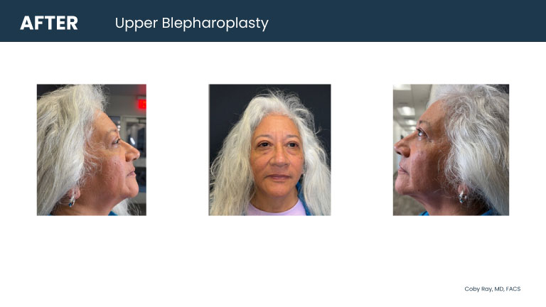 Patient shown from front and side angles after upper blepharoplasty by Dr. Coby Ray, showing a more open upper eyelid appearance.