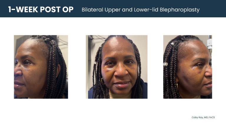 Patient shown from front and side angles one week after bilateral upper and lower-lid blepharoplasty by Dr. Coby Ray, with visible early post-operative healing around the eyes.