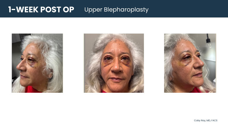 Patient shown from front and side angles one week after upper blepharoplasty by Dr. Coby Ray, with visible early post-operative healing around the upper eyelids.