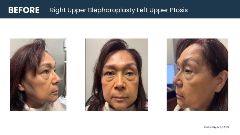 Patient shown from front and side angles with upper eyelid heaviness and ptosis prior to right upper blepharoplasty and left upper ptosis repair by Dr. Coby Ray.