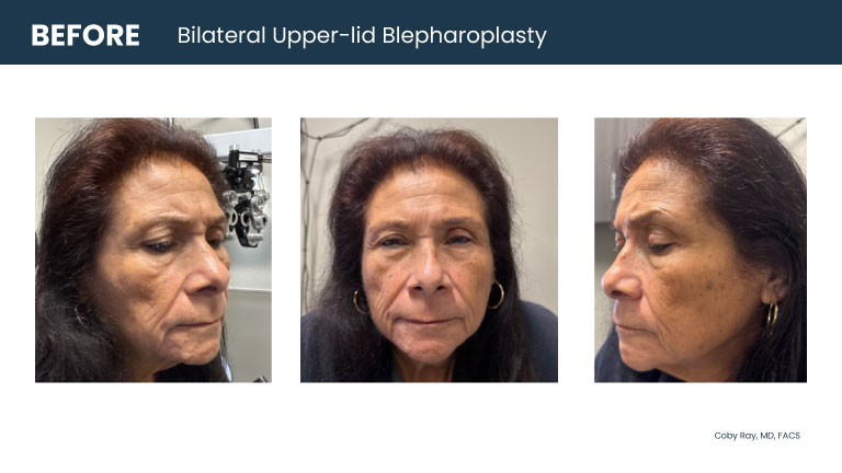 Patient shown from front and side angles with heavy upper eyelids before bilateral upper-lid blepharoplasty by Dr. Coby Ray.