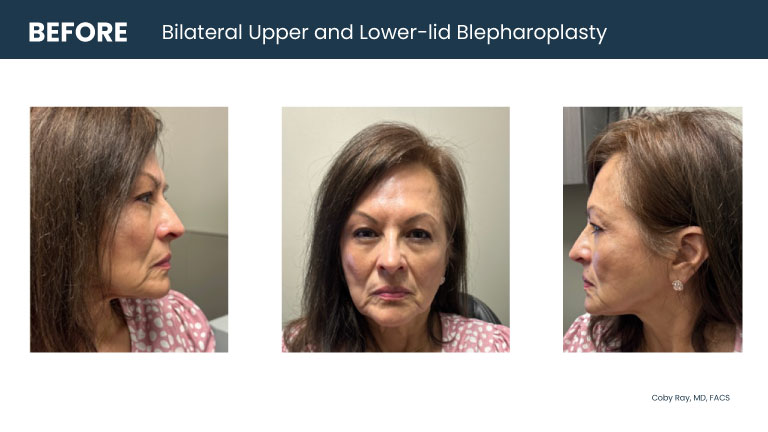 Patient shown from front and side angles with upper eyelid heaviness and lower eyelid bags before bilateral upper and lower-lid blepharoplasty by Dr. Coby Ray.