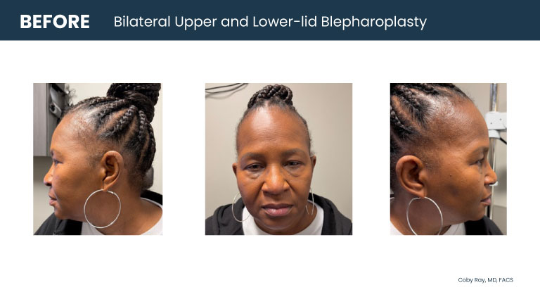 Patient shown from front and side angles with upper eyelid heaviness and lower eyelid fullness before bilateral upper and lower-lid blepharoplasty by Dr. Coby Ray.