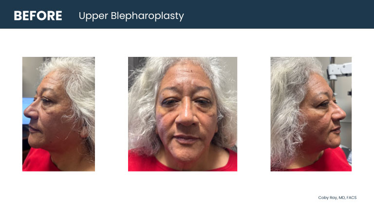 Patient shown from front and side angles with heavy upper eyelids before upper blepharoplasty by Dr. Coby Ray.