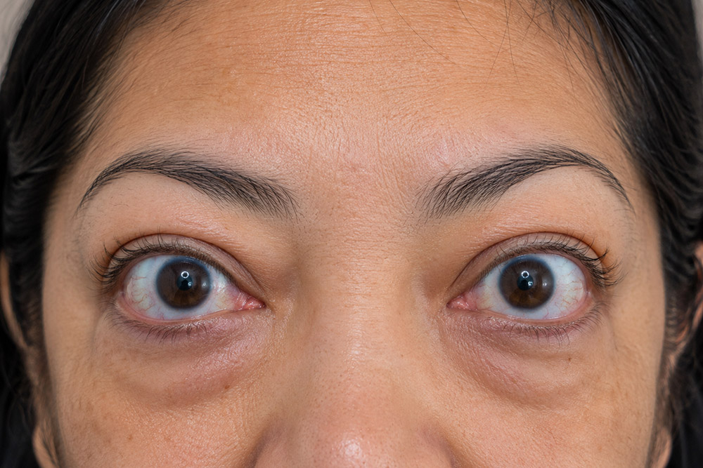 Close-up of a Mexican adult with prominent eyes, mild eyelid retraction, and subtle under-eye puffiness associated with thyroid eye disease.
