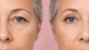 Before and after Blepharoplasty eyelid surgery to correct a hooded eyelid at West Texas Eye Associates.