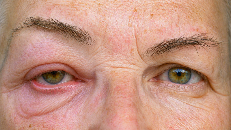 Close-up of an older patient’s eyes showing lower eyelid malposition with redness and irritation around one eye.