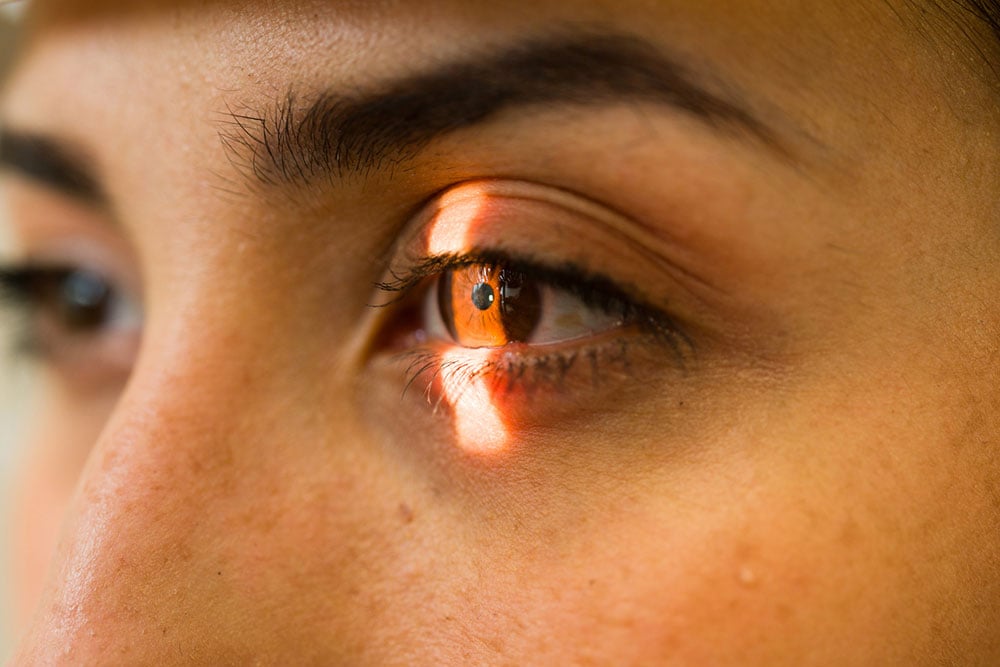 Close-up of an eye illuminated during a PRK eye surgery evaluation.