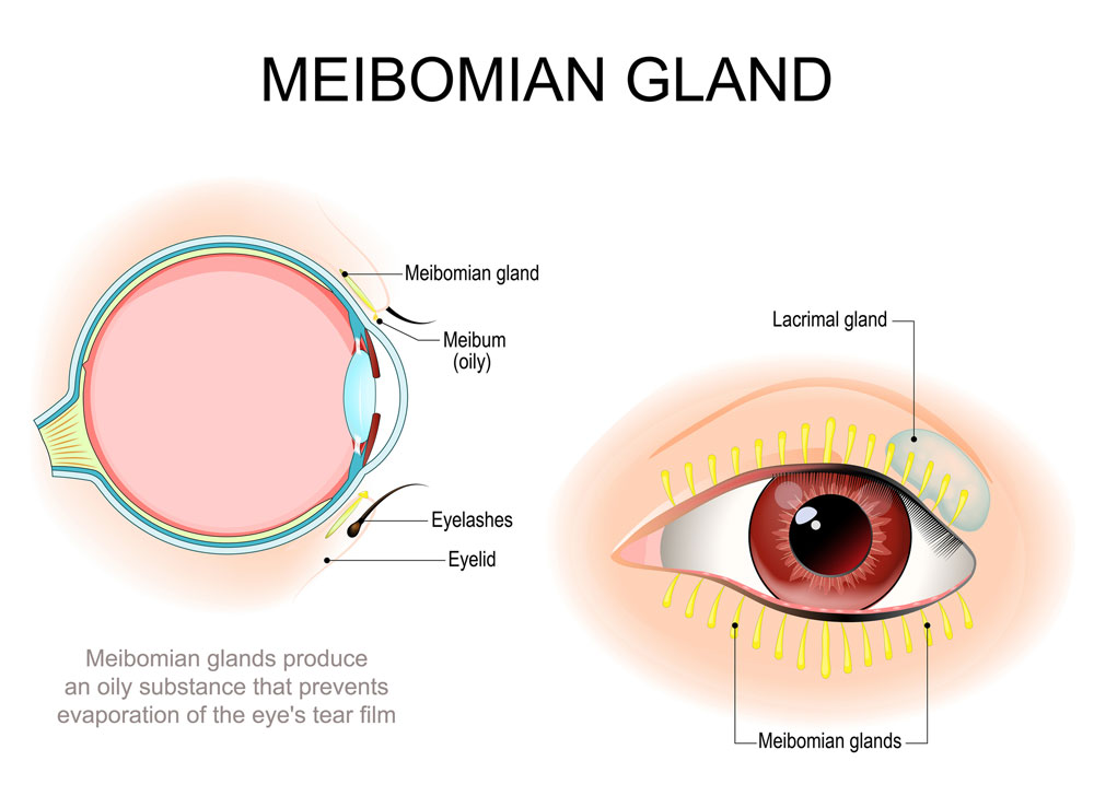 Imagery of an eye and meibomian gland affect dry eye.