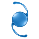 Blue intraocular lens (IOL) implant used in advanced cataract surgery to replace the eye’s natural lens.